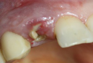 Зуб разрушен. Показано восстановление при помощи ортопедической конструкции