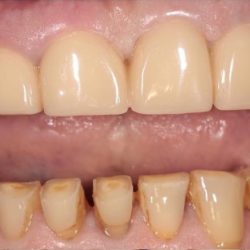 Зубные ряды до восстановления