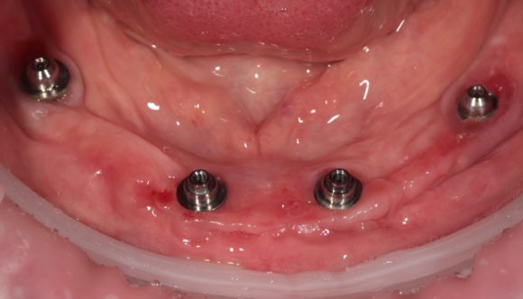 Четыре импланта Nobel Biocare установлены в челюсть. Пациент готов к установке искусственной челюсти