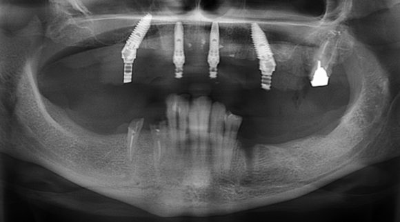 Рентгенологическая картина верхней челюсти: в кости установлены импланты Bio Care